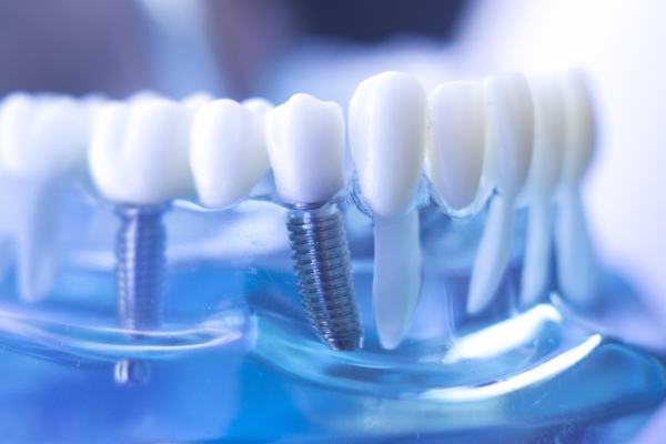 How To Fix Dental Implant Failure